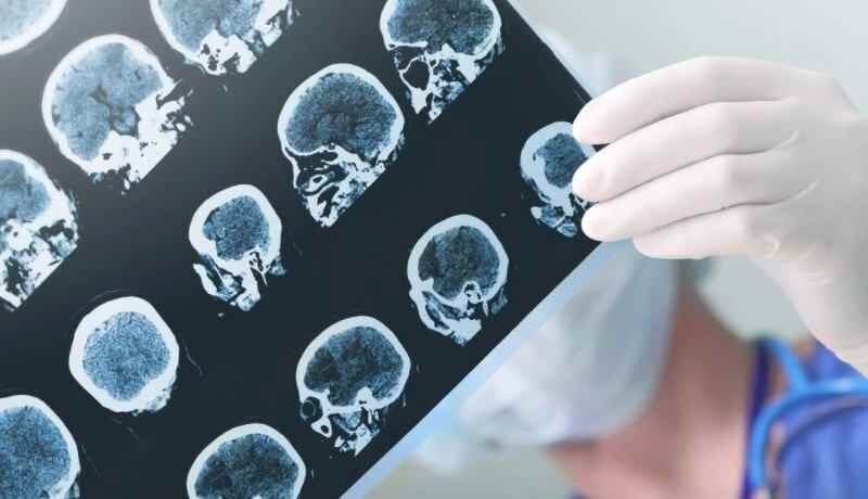 Aplicaciones Ayudan En Terapias De Lenguaje Tras Derrame Cerebral